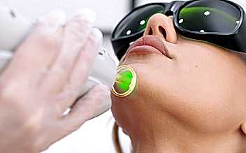 Лазерная эпиляция подбородка