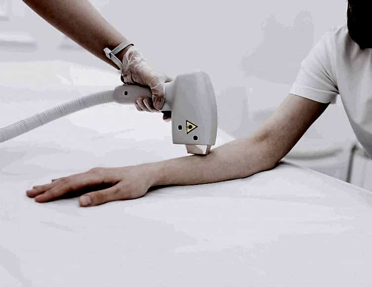 Эпиляция рук лазером: эффективное решение для гладкой кожи