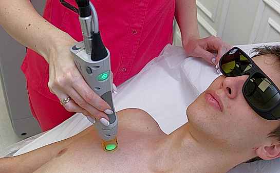 Лазерная эпиляция груди для мужчин