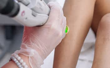 Лазерная эпиляция ног