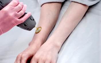 Лазерная эпиляция рук (полностью)