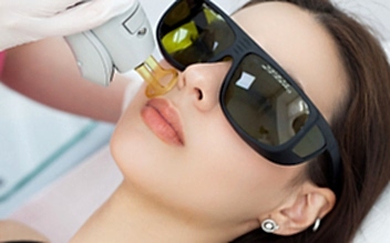 Лазерная эпиляция лица полностью