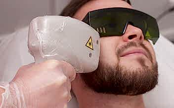 Лазерная эпиляция щёк для мужчин