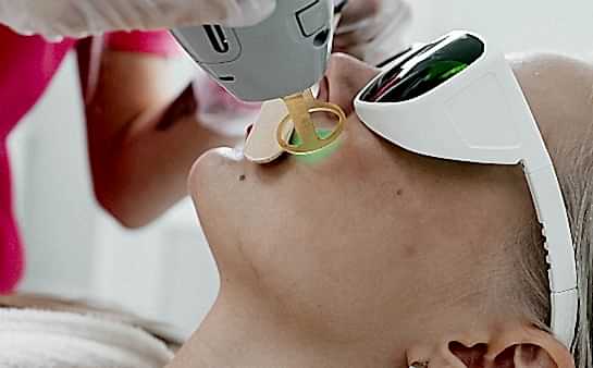 Лазерная эпиляция щёк