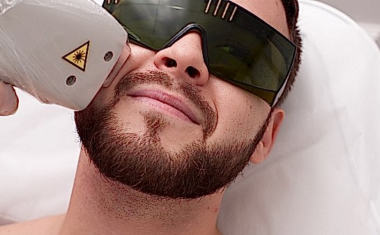 Лазерная эпиляция лица для мужчин
