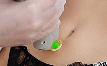 Лазерная эпиляция дорожки на животе