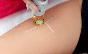 Лазерная эпиляция бёдер