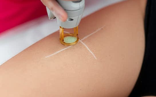 Лазерная эпиляция бёдер