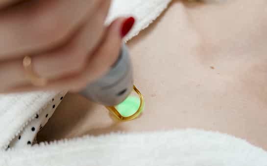 Лазерная эпиляция зоны декольте