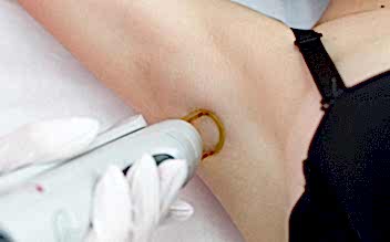 Лазерная эпиляция подмышек