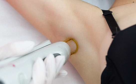 Лазерная эпиляция подмышек