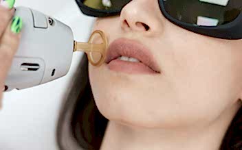 Лазерная эпиляция верхней губы