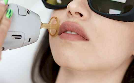 Лазерная эпиляция верхней губы