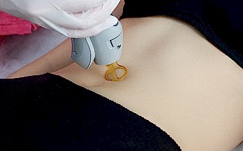 Лазерная эпиляция кожи живота