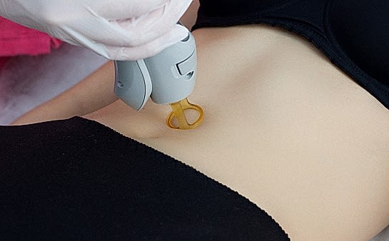 Лазерная эпиляция кожи живота